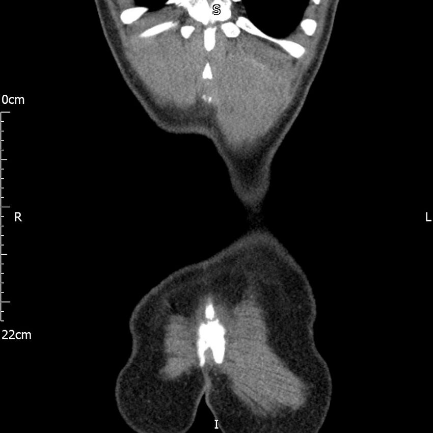Bilateral medullary nephrocalcinosis with ureteric calculi (Radiopaedia 71269-81569 Coronal non-contrast 72).jpg