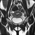 Bilateral ovarian endometriomas (Radiopaedia 87085-103347 Coronal T2 6).jpg