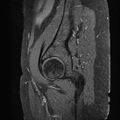 Bilateral ovarian endometriomas (Radiopaedia 87085-103347 F 1).jpg