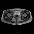 Bilateral ovarian fibroma (Radiopaedia 44568-48293 Axial T2 22).jpg
