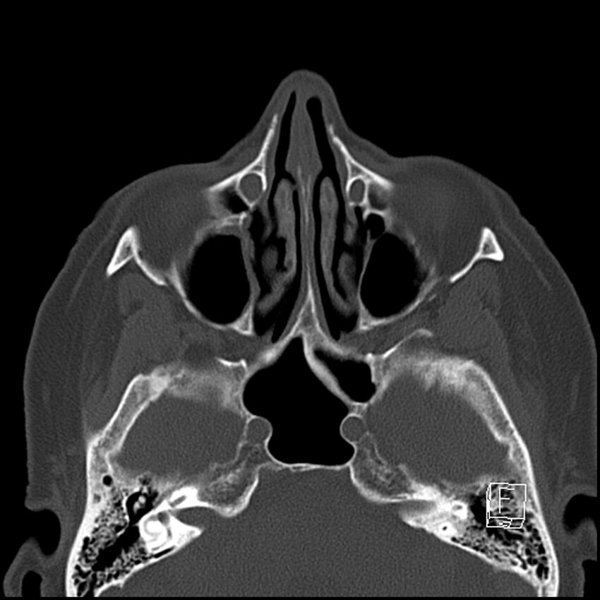 Bilateral palatine tonsilloliths on OPG and CT (Radiopaedia 75167-86247 Axial bone window 15).jpg