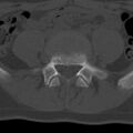 Bilateral pars defect (Radiopaedia 26691-26846 Axial bone window 47).jpg