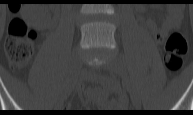 File:Bilateral pars defect (Radiopaedia 26691-26846 Coronal bone window 8).jpg