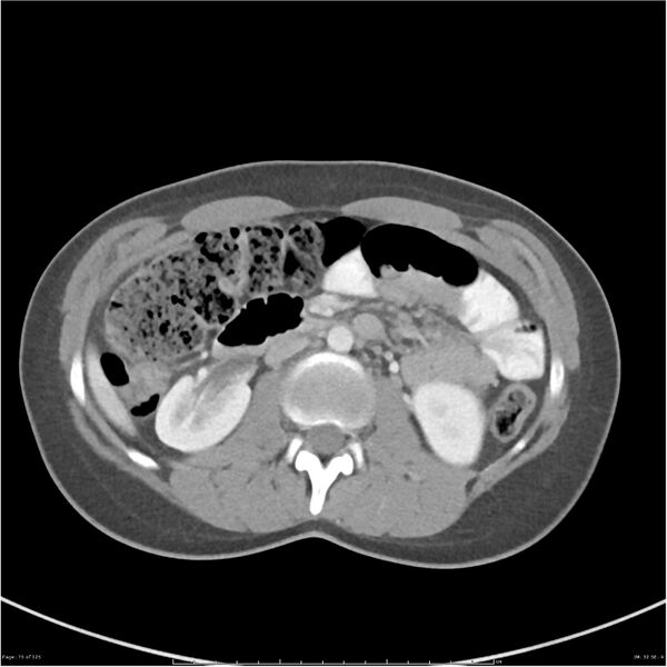 File:Bilateral ureteritis and cystitis (Radiopaedia 25340-25594 A 32).jpg
