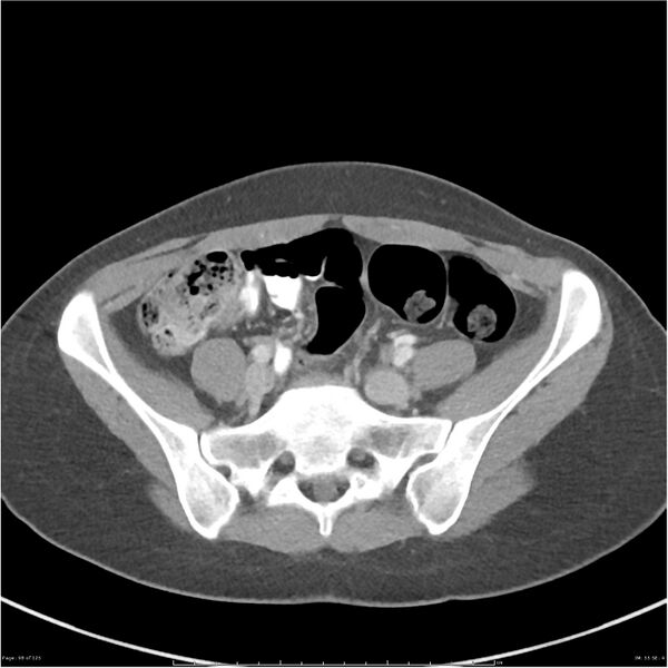File:Bilateral ureteritis and cystitis (Radiopaedia 25340-25594 A 55).jpg