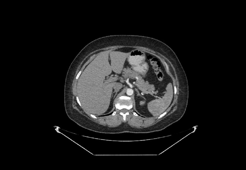 File:Bilateral urolithiasis with incidentally detected splenic artery aneurysm and left inferior vena cava (Radiopaedia 44467-48127 A 15).jpg