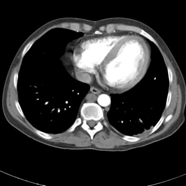 File:Biliary necrosis - liver transplant (Radiopaedia 21876-21845 A 2).jpg