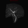 Biliary tree anatomical variant - biliary trifurcation (Radiopaedia 12531-12750 Coronal 3D MRCP 6).jpg