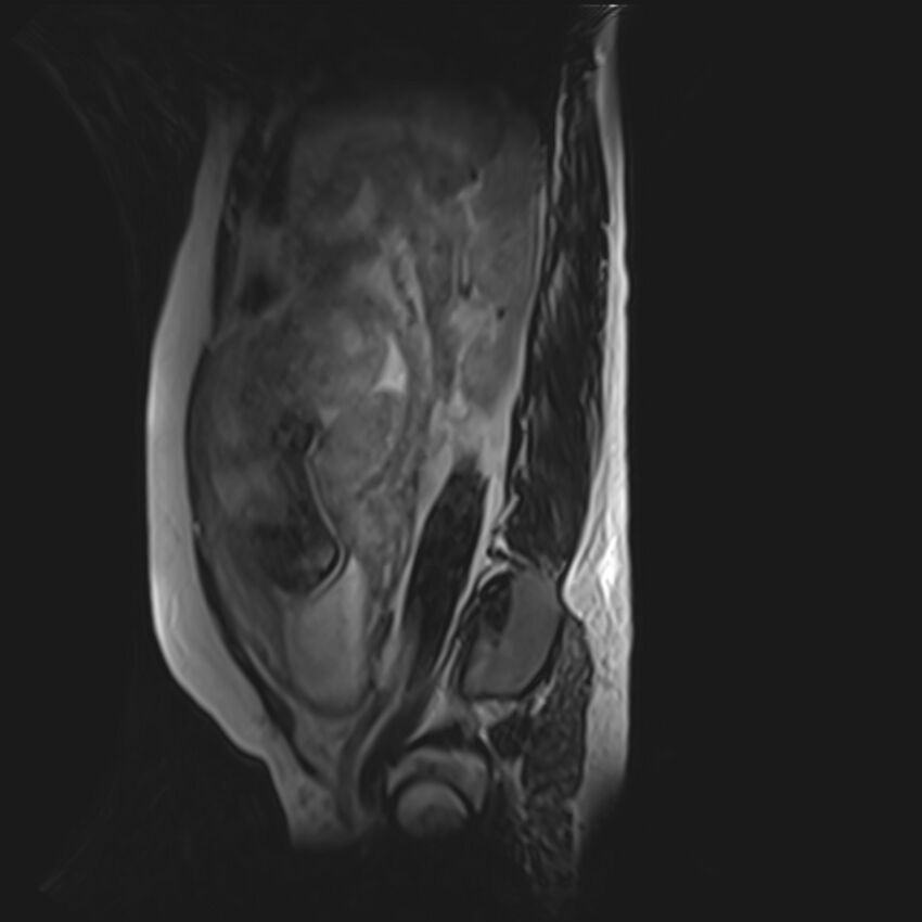 Bilobed placenta accreta (Radiopaedia 69648-79591 G 17).jpg