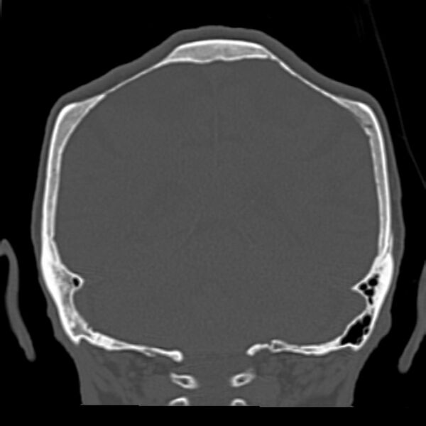 File:Biparietal osteodystrophy (Radiopaedia 46109-50463 Coronal bone window 75).jpg