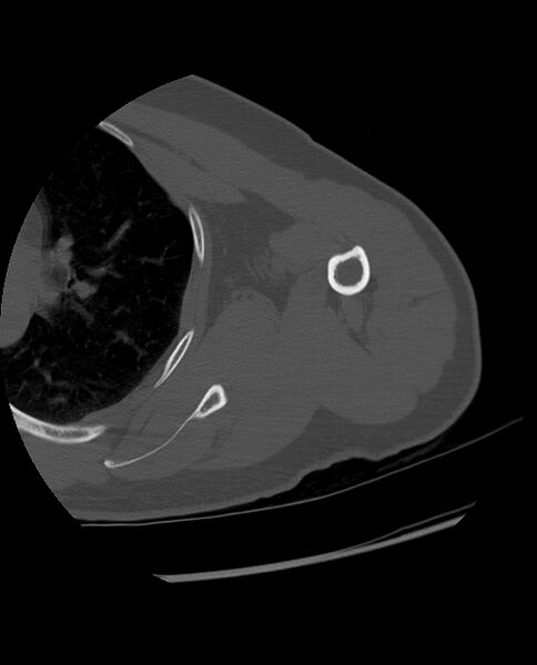 File:Bizarre parosteal osteochondromatous proliferation (Radiopaedia 84221-99501 Axial bone window 20).jpg