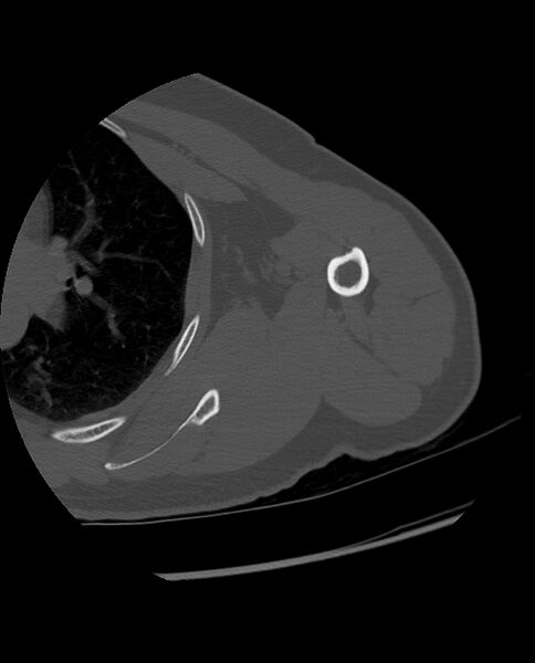 File:Bizarre parosteal osteochondromatous proliferation (Radiopaedia 84221-99501 Axial bone window 26).jpg