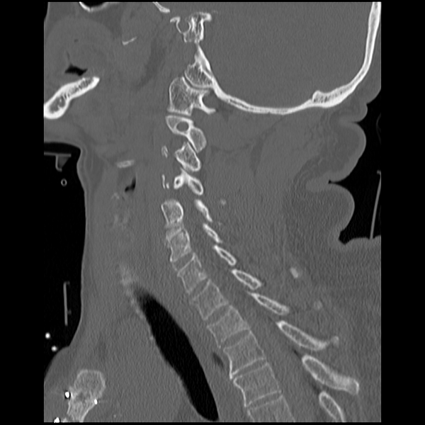 File:Blunt cerebrovascular injury (Radiopaedia 53682-59743 Sagittal bone window 14).png