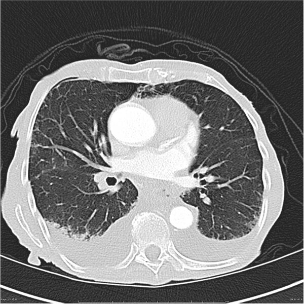 File:Boerhaave syndrome (Radiopaedia 26240-26362 Axial lung window 27).jpg
