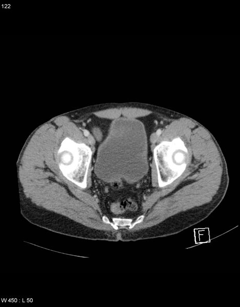 File:Boerhaave syndrome with tension pneumothorax (Radiopaedia 56794-63603 A 61).jpg