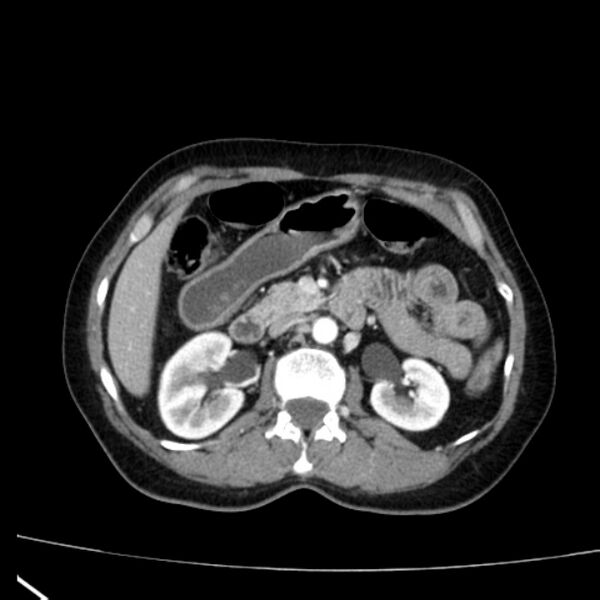 File:Bosniak renal cyst - type I (Radiopaedia 27479-27675 renal cortical phase 31).jpg