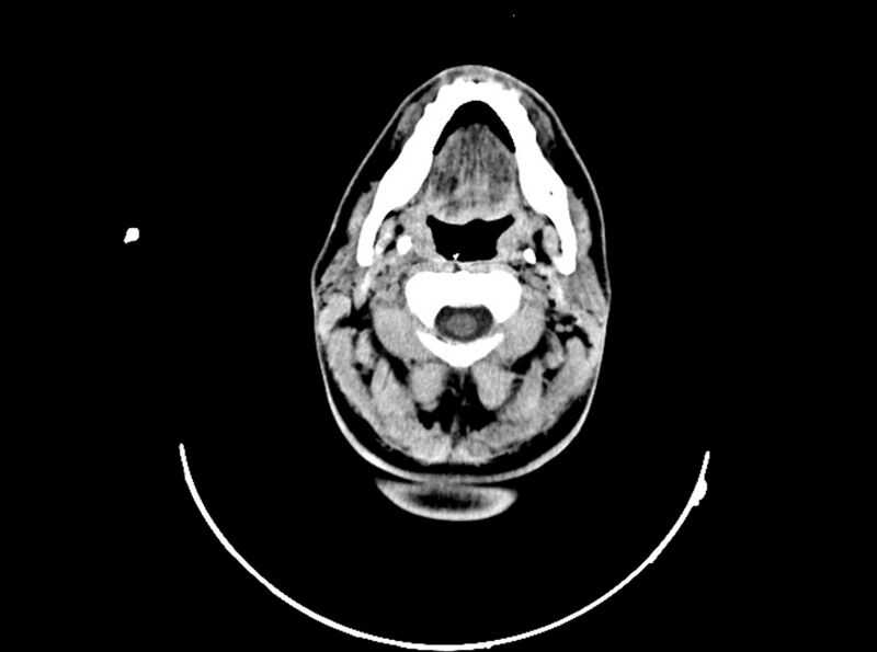 File:Brain injury by firearm projectile (Radiopaedia 82068-96088 A 45).jpg