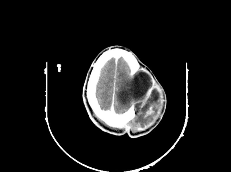 File:Brain injury by firearm projectile (Radiopaedia 82068-96088 B 183).jpg