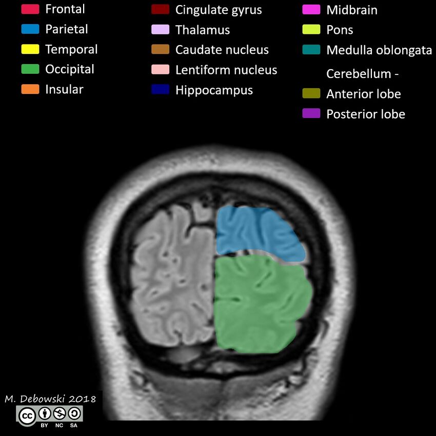 Brain lobes - annotated MRI (Radiopaedia 61691-69700 Coronal 67).JPG