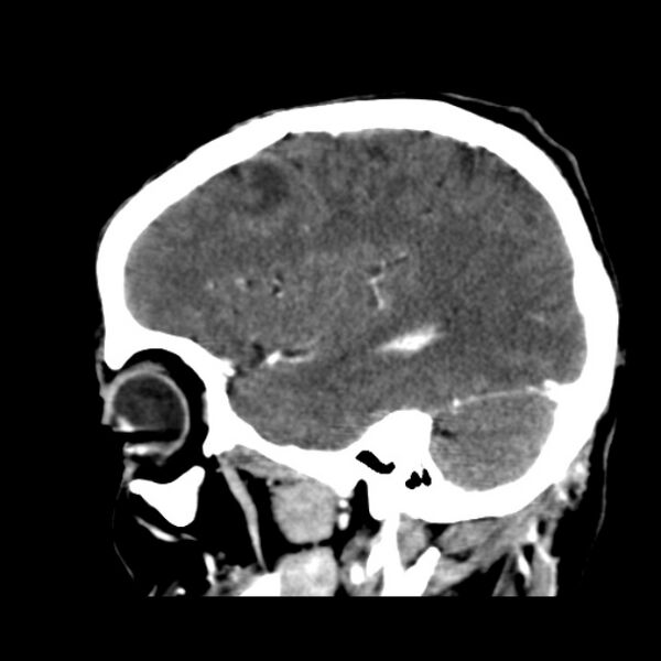 File:Brain metastases from lung cancer (Radiopaedia 24480-24781 C+ delayed 43).jpg