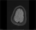 Brainstem glioma (Radiopaedia 21819-21775 Axial FLAIR 34).jpg