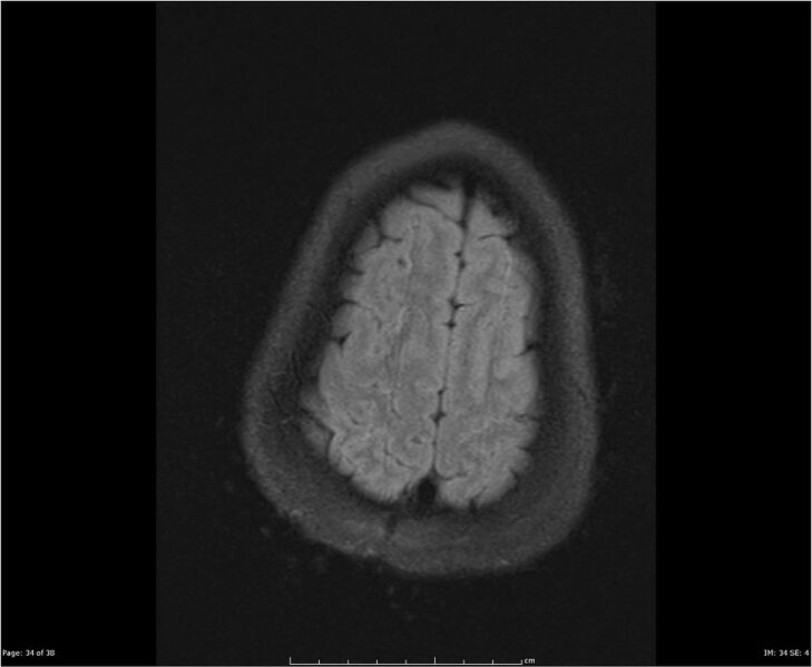 File:Brainstem glioma (Radiopaedia 21819-21775 Axial FLAIR 34).jpg