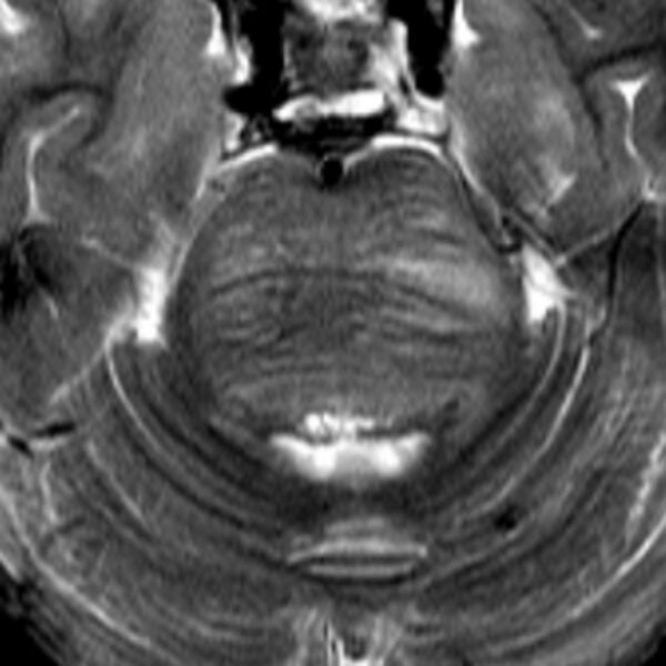 File:Brainstem glioma (Radiopaedia 5683-7390 G 1).jpg