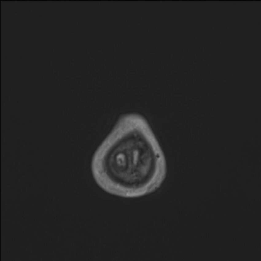 Brainstem glioma (Radiopaedia 70548-80674 Axial T1 C+ 152).jpg