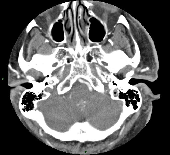 File:Brainstem hemorrhage (Radiopaedia 58794-66028 D 35).jpg