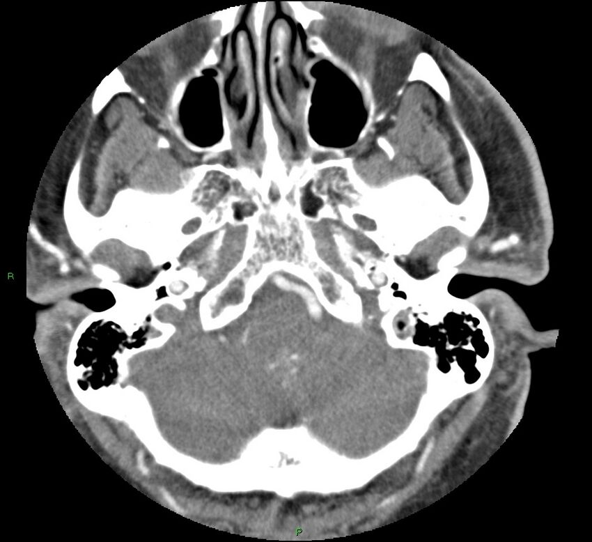 Brainstem hemorrhage (Radiopaedia 58794-66028 D 35).jpg