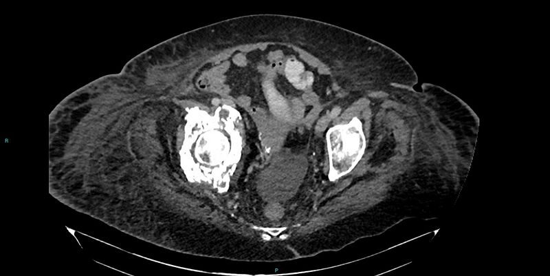 File:Breast cancer pelvic bony metastases (Radiopaedia 84470-99824 Axial bone window 50).jpg