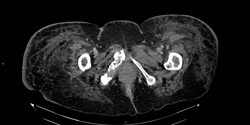 File:Breast cancer pelvic bony metastases (Radiopaedia 84470-99824 Axial bone window 77).jpg