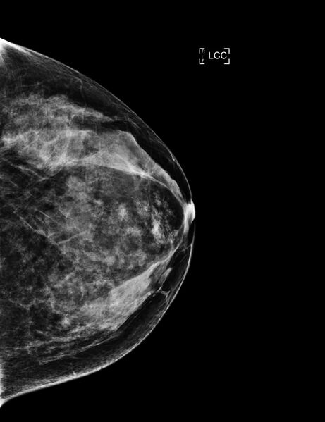 File:Breast hamartoma (Radiopaedia 65421-74481 D 1).jpg