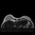 Breast implants - MRI (Radiopaedia 26864-27035 Axial T2 8).jpg