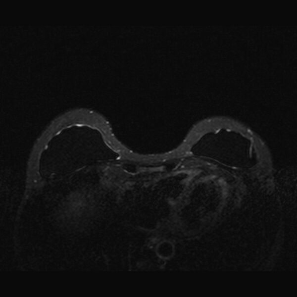 File:Breast implants - MRI (Radiopaedia 26864-27035 T2 SPAIR 16).jpg