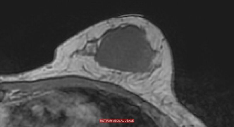File:Breast lymphoma (MRI) (Radiopaedia 34999-36498 Axial T1 13).jpg