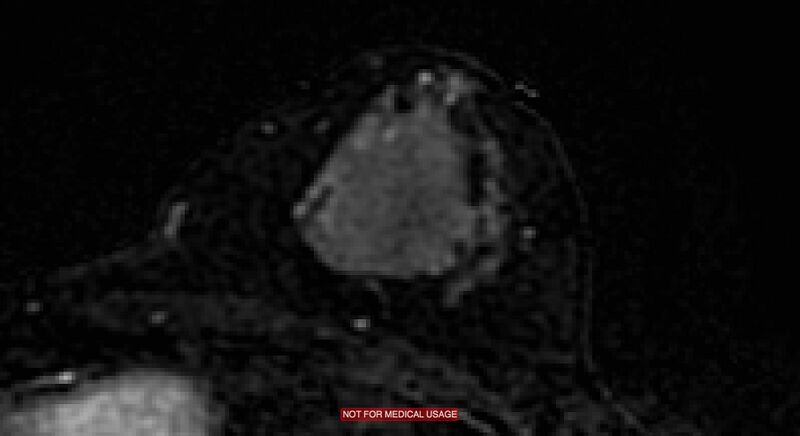 File:Breast lymphoma (MRI) (Radiopaedia 34999-36498 C 5).jpg