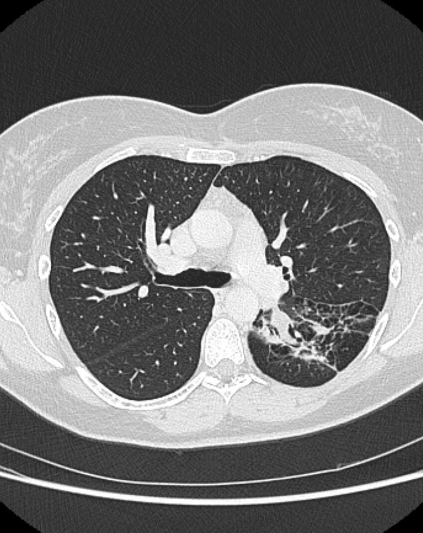 Bronchial atresia (Radiopaedia 50007-55297 Axial lung window 40).jpg