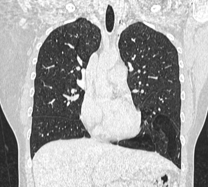 Bronchial atresia (Radiopaedia 50007-55297 Coronal lung window 42).jpg