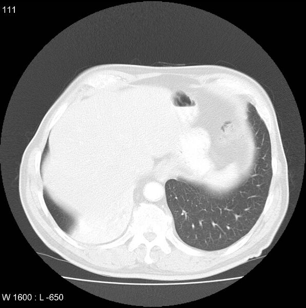 File:Bronchial carcinoid tumor with right lower lobe collapse (Radiopaedia 29060-29422 B 49).jpg