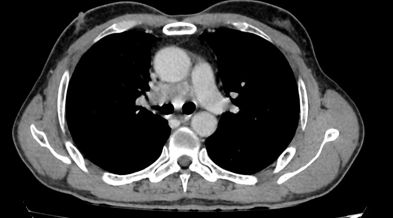 File:Bronchogenic carcinoma with superior vena cava syndrome (Radiopaedia 36497-38054 Axial C+ delayed 40).jpg