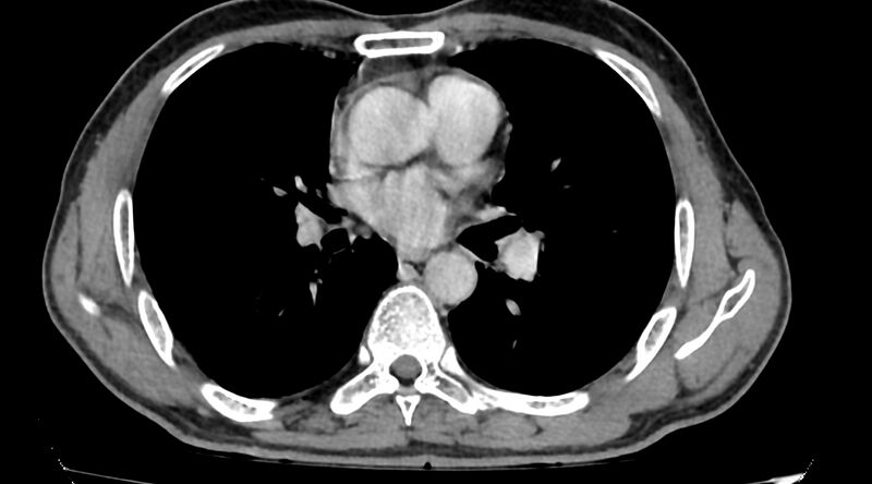 File:Bronchogenic carcinoma with superior vena cava syndrome (Radiopaedia 36497-38054 Axial C+ delayed 52).jpg