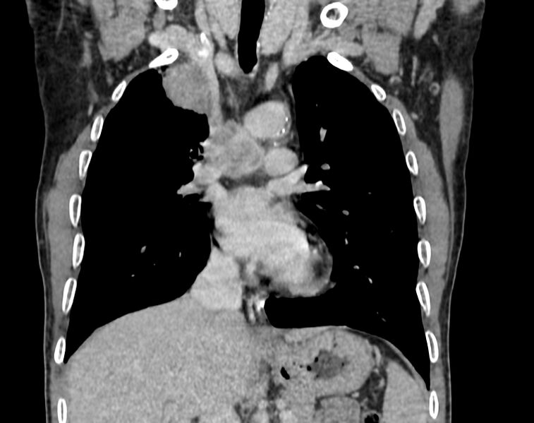 File:Bronchogenic carcinoma with superior vena cava syndrome (Radiopaedia 36497-38054 Coronal C+ delayed 34).jpg