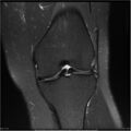 Bucket handle tear - lateral meniscus (Radiopaedia 7246-8187 Coronal T2 fat sat 12).jpg