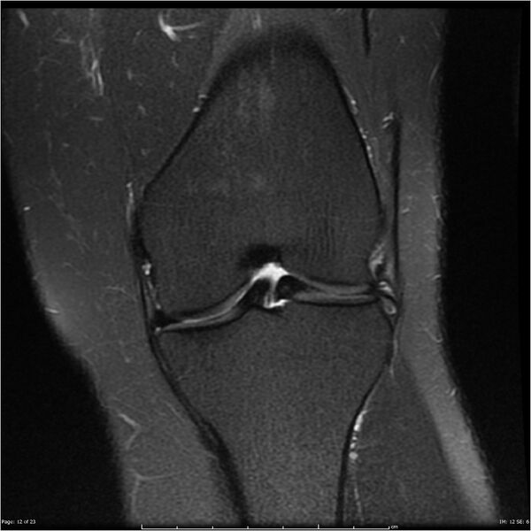 File:Bucket handle tear - lateral meniscus (Radiopaedia 7246-8187 Coronal T2 fat sat 12).jpg