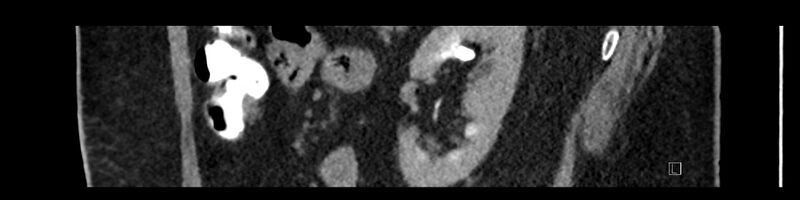 File:Buried bumper syndrome - gastrostomy tube (Radiopaedia 63843-72575 Sagittal Inject 36).jpg