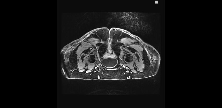 Buttock filler complications (Radiopaedia 63497-72115 Axial T1 C+ 30).jpg