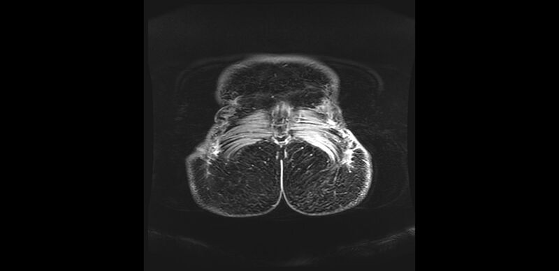 File:Buttock filler complications (Radiopaedia 63497-72115 Coronal T1 C+ 62).jpg