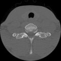 C5 facet fracture (Radiopaedia 58374-65499 Axial bone window 76).jpg