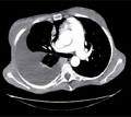 Mucinous borderline tumor: Thoracic axial CT-scan showing a right pleural effusion
